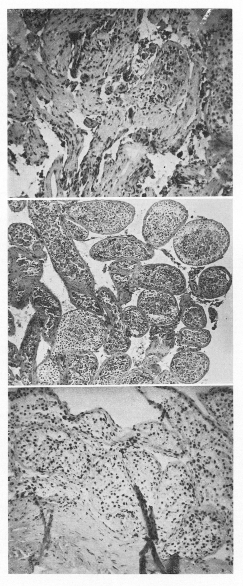 OLIGOSPERMIA TREATMENTS Fig. 7. (G. T.) Oligospermia and hypospermatogenesis.