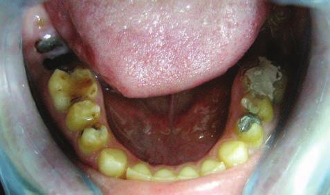 teeth were prepred for direct composite resin lminte veneer restortions.