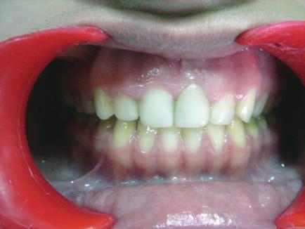 CLINICAL DENTISTRY AND RESEARCH were etched with the phosphoric cid for 15 s nd rinsed.