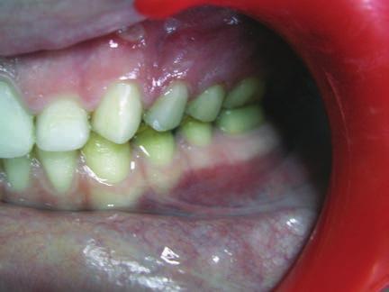 During the control in the first yer, clinicl nd rdiogrphic exmintion reveled new pproximl crious lesion in left mxillry first premolr nd frcture t left mxillry second premolr s veneer restortion