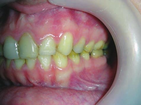 17 stted tht complex composite restortions in permnent hypominerlized molrs with defective enmel offer good, long