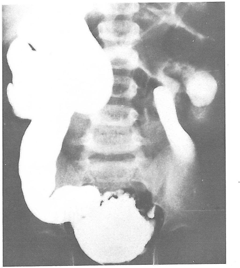 N. Simforoosh, M.D. TABLE I. GIL-VERNET ANTIREFLUX PROCEDURE IN EIGHT BOYS WITH VU REFLUX PERSISTENT FOLLOWING V ALVE ABLATION.