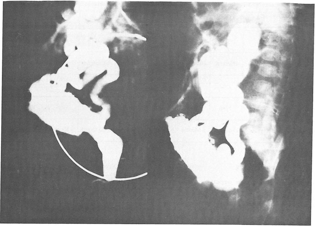A New Approach To Vesicoureteral Reflux Fig 3A. Grade V vesicoureteral reflux in a 9 months old boy with posterior urethral valve.
