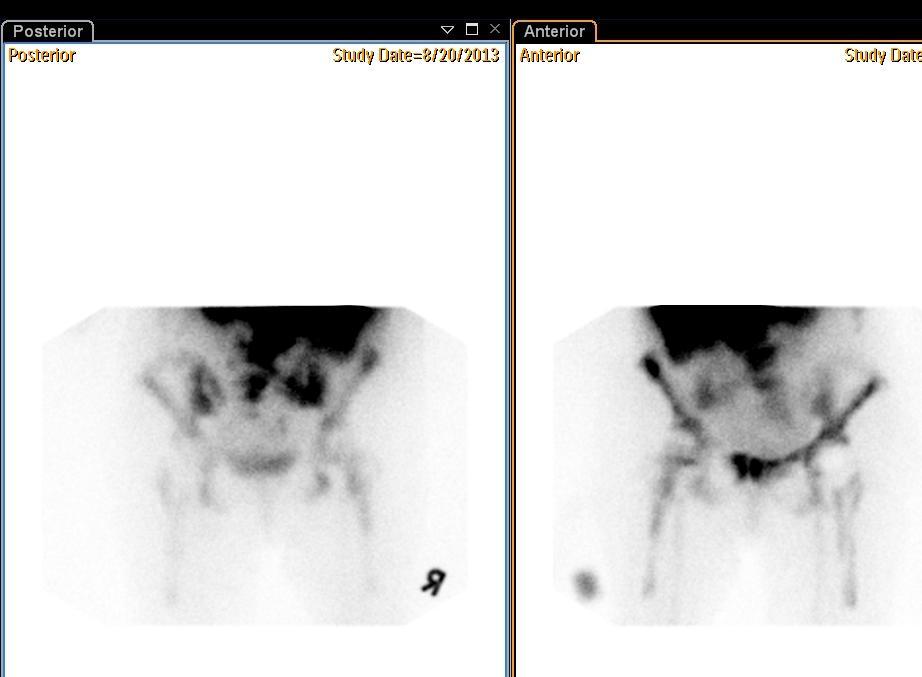 Bone marrow scintigraphy. Conclusion: Leucocytes are located in the red marrow.