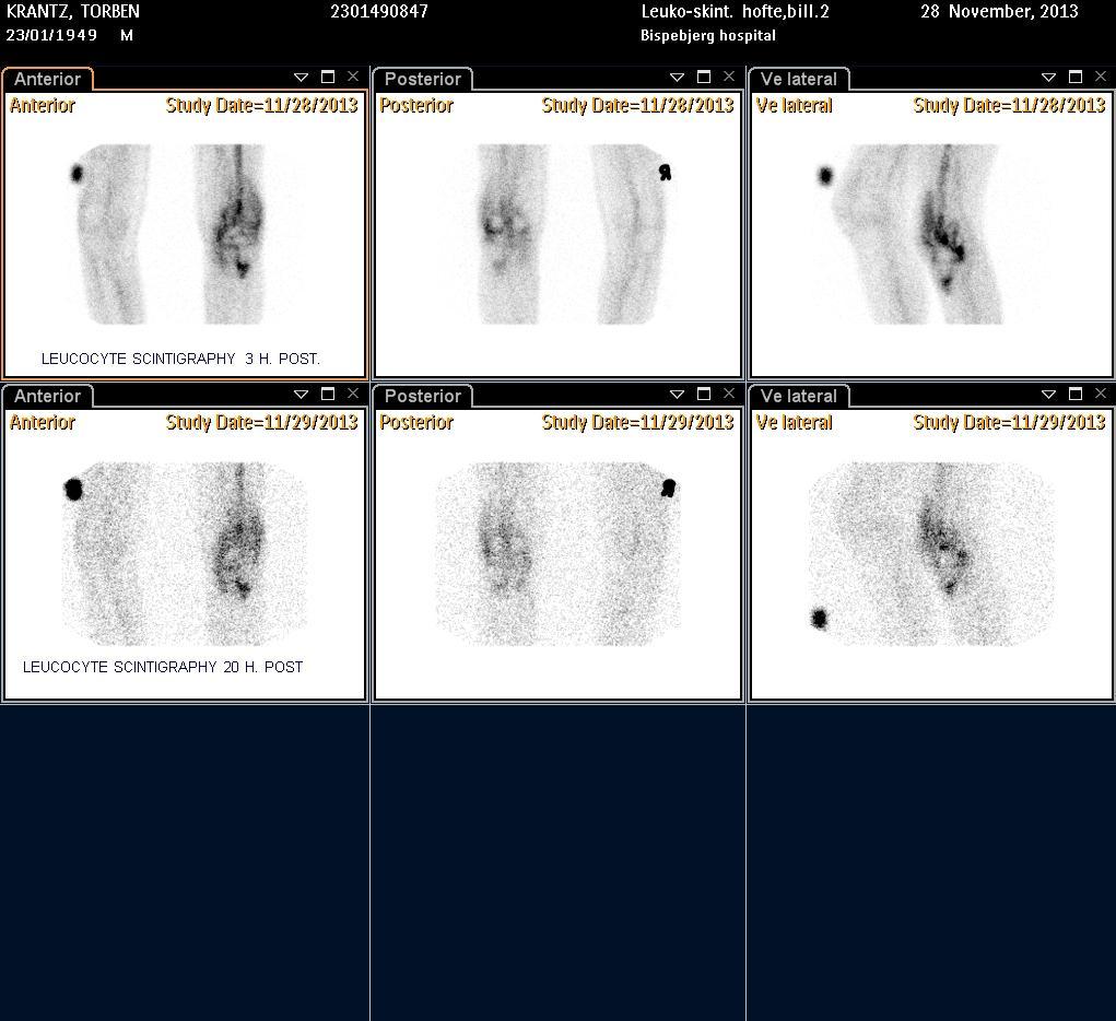 Leucocytescintigraphy shows increased neutophile leucocytes around the prosthesis and