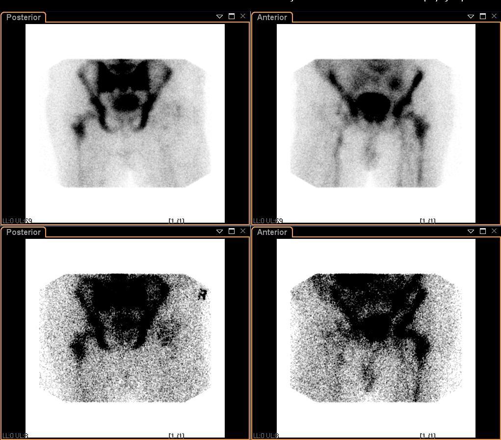 Leucocytscintigraphy with 99m Tc-HMPAO