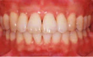 However, in severe forms of disease such as early onset aggressive periodontitis treatment may require the use of antibiotics.