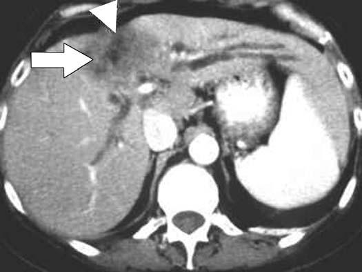 Fig. 2. 45-year-old woman with cholangiocarcinoma.