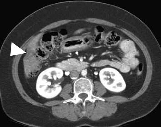 Cholangiocarcinoma may cause hepatic atrophy and capsular retraction [2] (Fig. 2), probably due to combined venous and biliary occlusion of the atrophic part of the liver.
