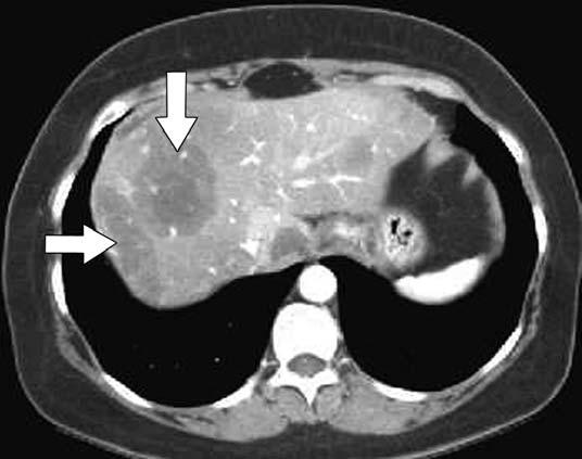 Hepatocellular carcinoma may be variably exophytic [2], causing bulging of the hepatic contour (Fig. 3). Fig. 3. 50-year-old man with hepatocellular carcinoma.