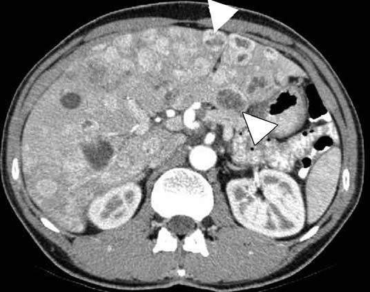 Contrast-enhanced CT scan shows bulging of liver contour (arrow) due to hypoattenuating mass with interrupted