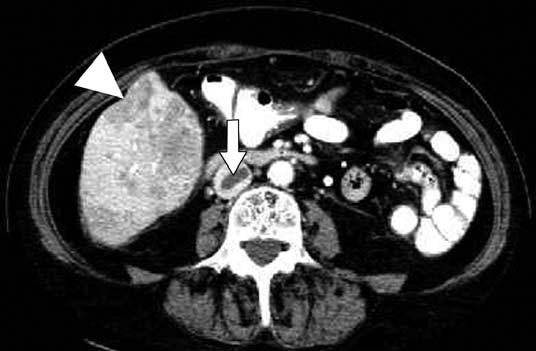 A Fig. 8. 60-year-old man with untreated metastatic colon cancer. Contrast-enhanced CT scan shows hypoattenuating liver masses.