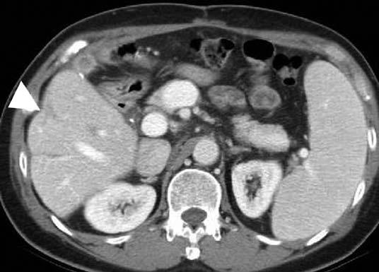 Fig. 11. 29-year-old woman with liver infarct after having undergone liver transplantation.