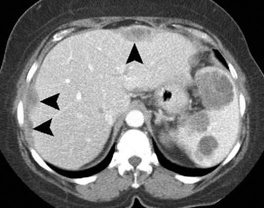 to liver. Contrast-enhanced CT scan shows diffusely lobulated liver contour and ascites. Fig. 14.