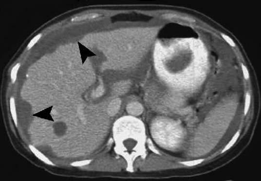 Contrast-enhanced CT scan shows biconvex perihepatic implants (arrowheads) that indent hepatic contour.