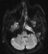 By location: cholesteatoma and ddx EAC Middle ear Mastoid Petrous Apex Non-cholesteatomatous inflammatory processes Necrotizing external otitis Facial nerve Inner ear Ossicular complications