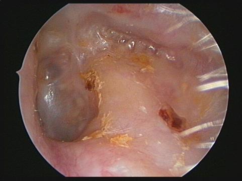 Canal-wall down: Mastoid cavity Aural toilet Water exclusion Hearing reconstruction