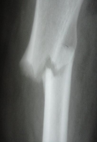 She underwent open reduction and internal fixation of the fracture using a 95 o angled blade plate (Figure 3). Alendronate was stopped on admission, but the calcium was continued.