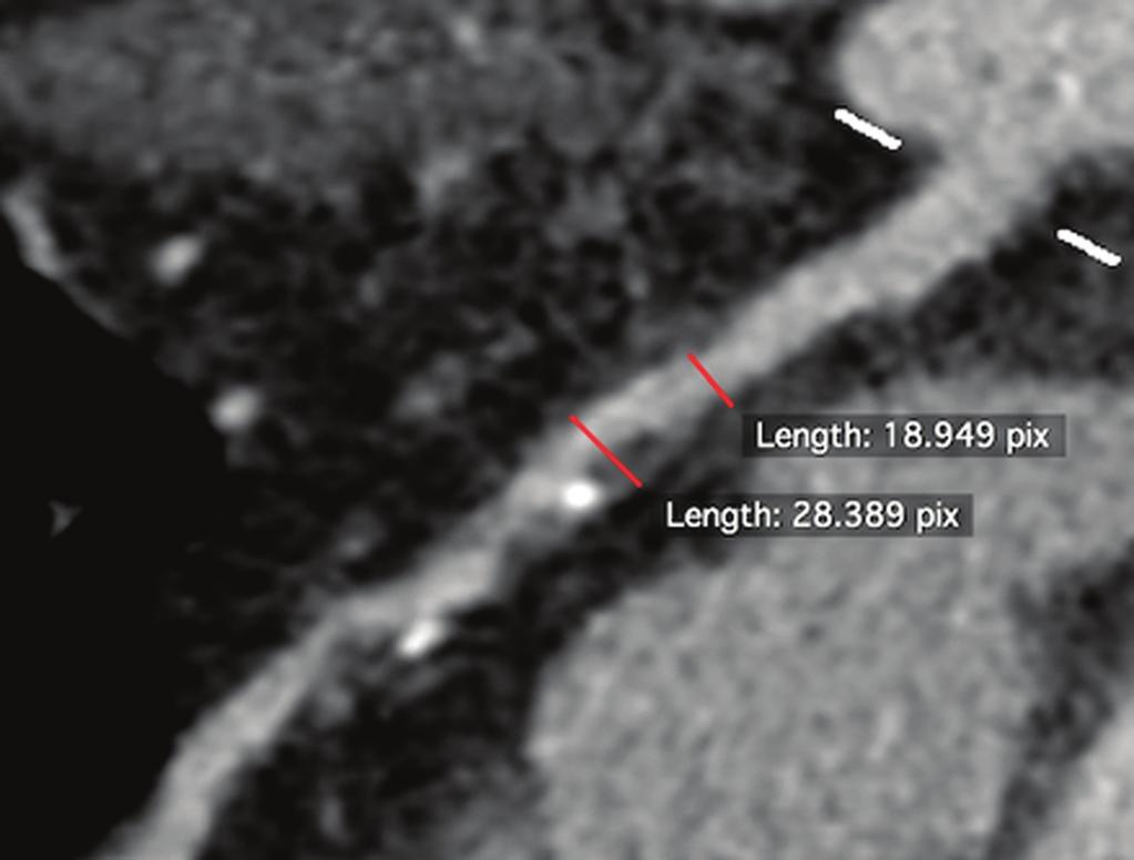 reveals proximal LD plaque
