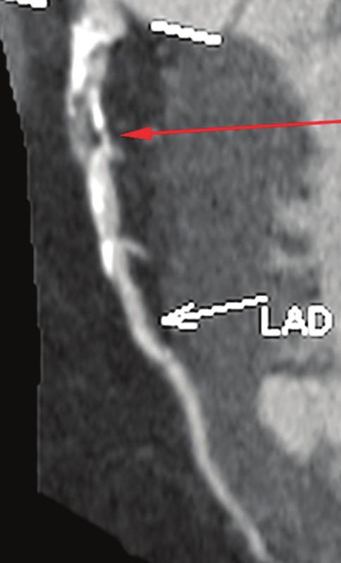 proximal LD; there is also a soft tissue component which is very