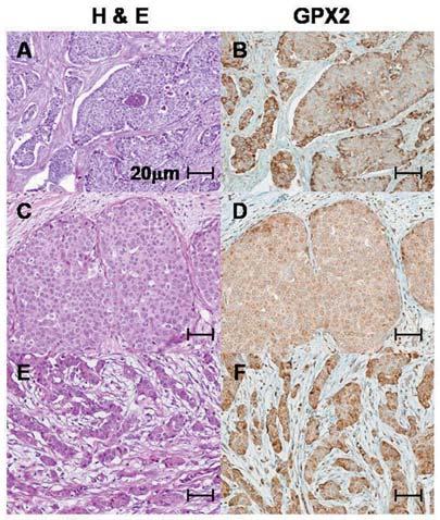 Non-tumorous mammary glands of Hras rats were completely negative. GPX GPX GPX Figure GPX GPX sirna Figure. Histological appearance of human breast cancers and GPX immunohistochemical staining.