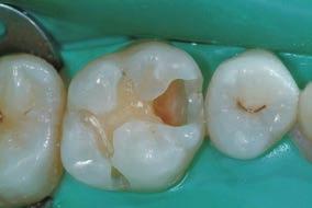 37 - Preoperative occlusal view of upper 1st molar demonstrates the presence of a