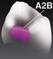 6 Class II restoration for small cavity Bulk filling technique is effective for proximal small cavities, a body shade is