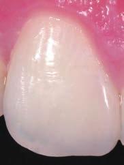Class IV restor ation Fig.74, 75 - An increment of NE is placed in incisal area and contoured to the final anatomical form. The surface is smooched with a brush. Light cure for 10 seconds. 4 Fig.