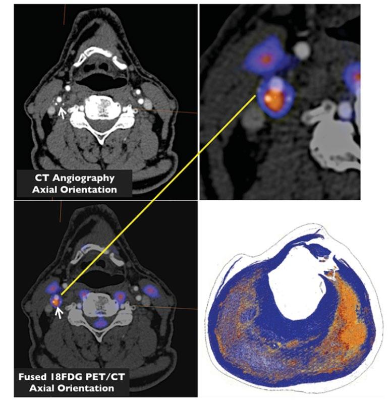 Plaque inflammation on PET/CT correlates with inflammation on histology CD 45 staining