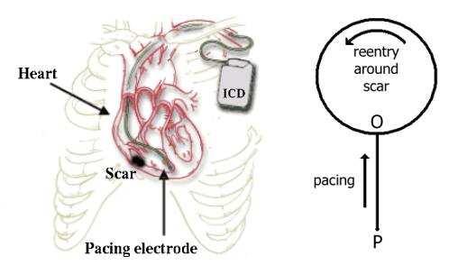 Johannes Breuer and Sitabhra Sinha Figure 1. (Left) Schematic diagram of anti-tachycardia pacing in the heart using an ICD (adapted from a figure courtesy of Guidant Corp.). Note the non-conducting scar tissue (in black) occupying a significant portion of the ventricle.