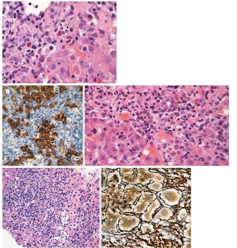 necrosis and inflammation, *multinucleated hepatocytes, *broad areas of parenchymal collapse!
