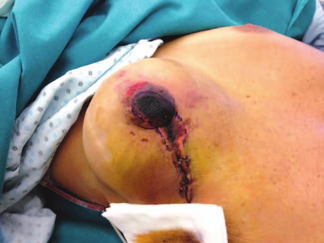 Chirappapha et al. Nipple Sparing Mastectomy close to the dermis and from the pectoral fascia.