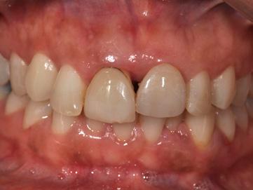 morphology, disproportions and discolorations with contemporary composite restorations.