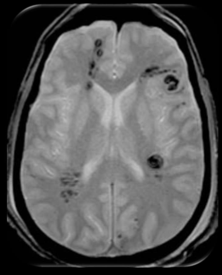 Diffuse Axonal Injury Deceleration injury- usually MVA Shear-strain forces on the axons during