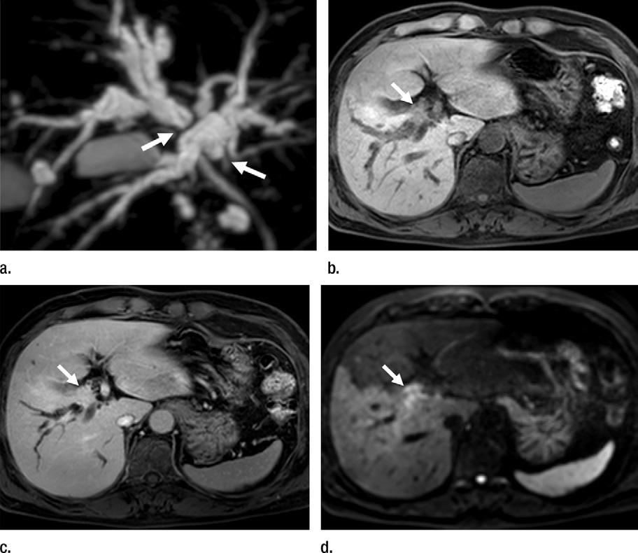Figure 1 Figure 1: Images in 54-year-old man with Bismuth-Corlette type IIIa hilar cholangiocarcinoma.