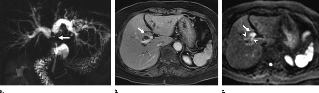 (b) Unenhanced and (c) gadoxetic acid enhanced three-dimensional gradient-echo 3-minute delayed phase images show thickening of the bile duct at the hepatic hilum (arrow) with gradual