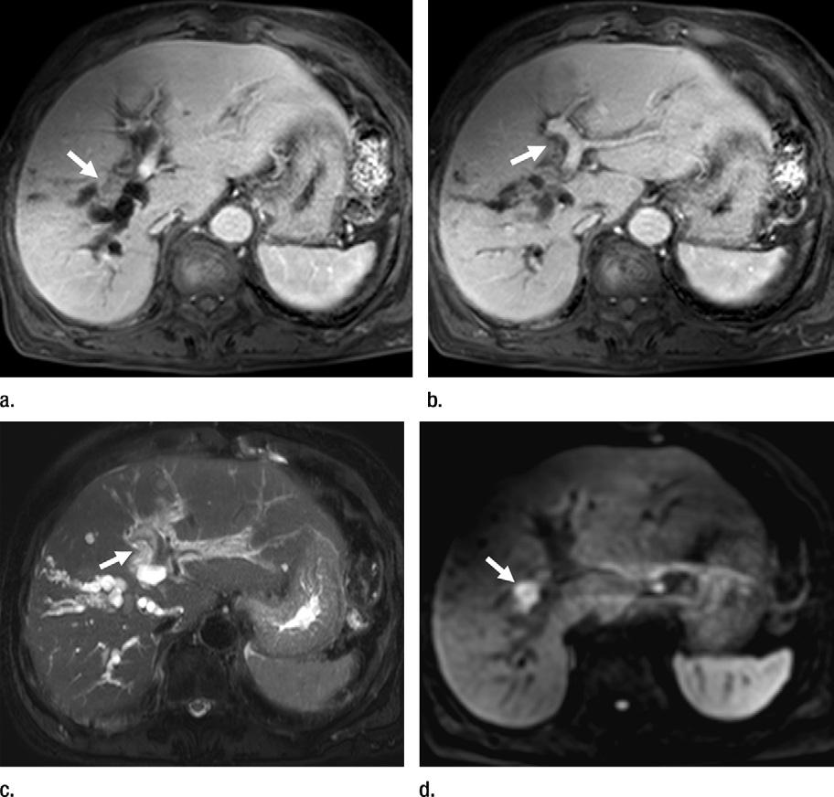 Figure 3 Figure 3: Images in 76-year-old man with Bismuth-Corlette type IIIa hilar cholangiocarcinoma who had undergone a left percutaneous transhepatic biliary decompression procedure before MR