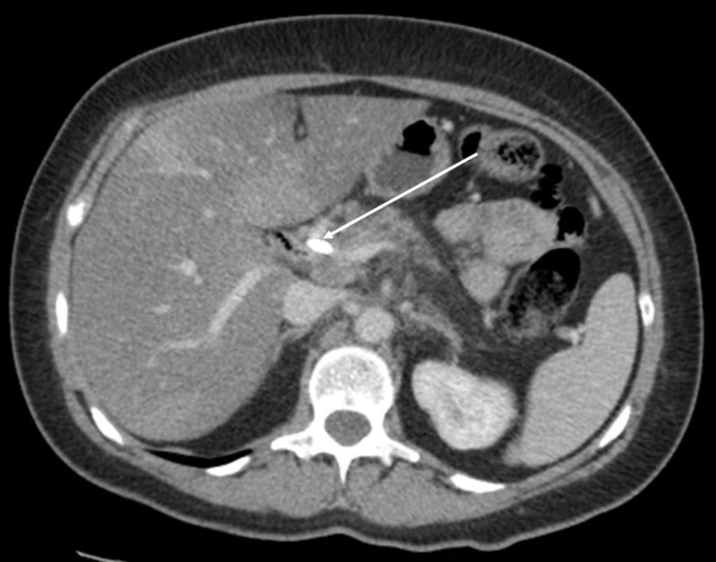 Fig. 7: A 44yr old female, underwent ERCP for obstructive jaundice and mild pancreatitis. She was found to have a tight stricture - biliary stent inserted. CT Abdomen - portal venous phase.