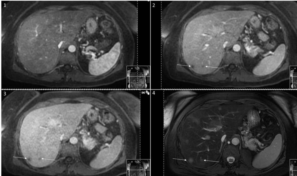 Fig. 8: MRI with Primovist contrast - 1. arterial, 2. Portal venous and 3.