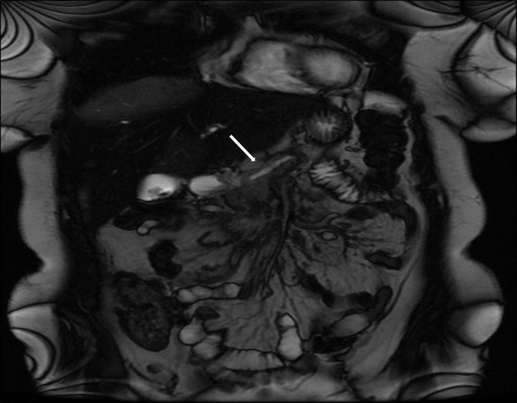 Fig. 9: Coronal MRI - showing abnormal soft tissue at the level of the pancreatic head (arrow) which appears to