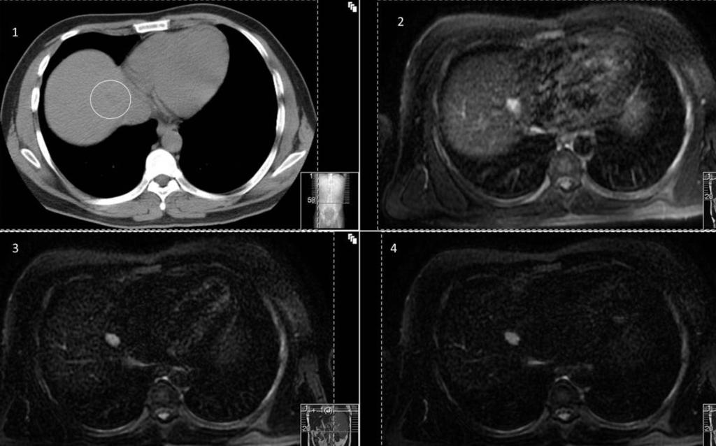 Fig. 11: A 37yr old male presented with abnormal liver functions. He was found to have gastric varices on gastroscopy.