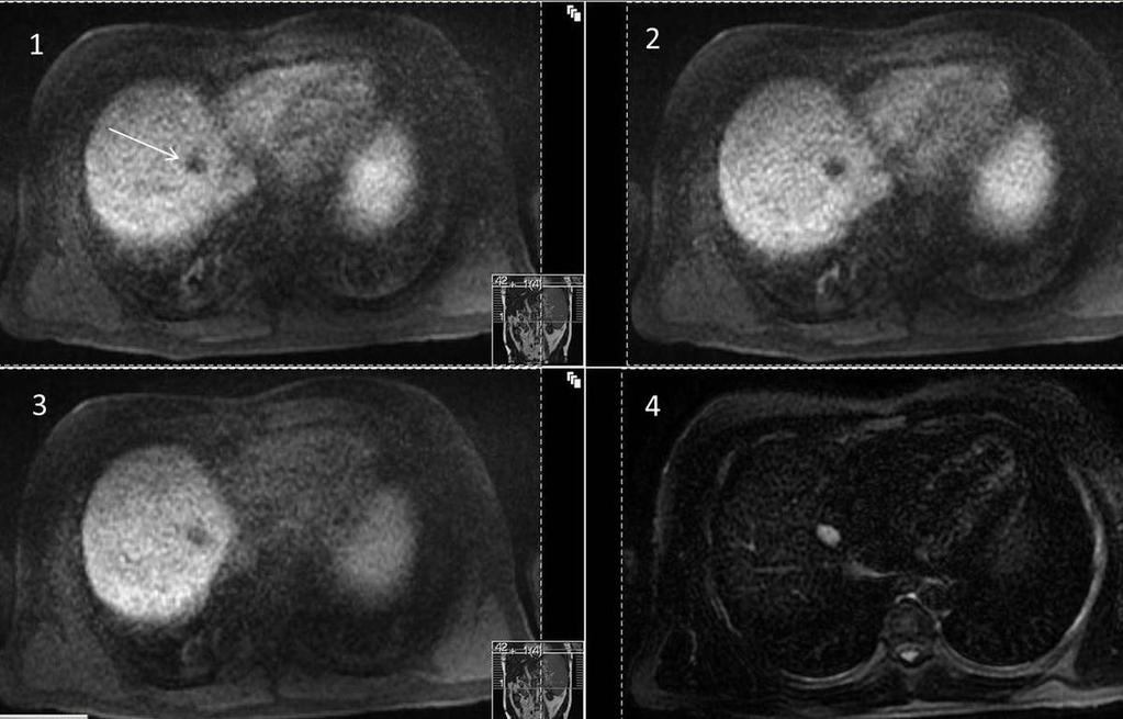 Fig. 12: MRI of cyst (arrow) showing non enhancement during all phases of Primovist contrast inkeeping with a simple cyst.