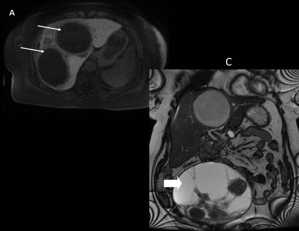 Fig. 14: MRI Liver (Axial Post Primovist Hepatocyte phase (A) & coronal FIESTA (C) ) - showing two large cysts present within the right lobe of the liver (thin arrows).