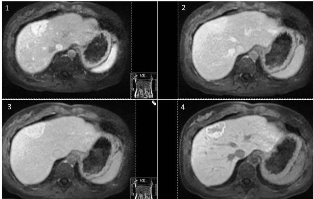 Fig. 6: MRI with Primovist - showing a 33mm lesion is visible at the junction of segment 4A and 8 of the liver, lying predominantly within segment 8.