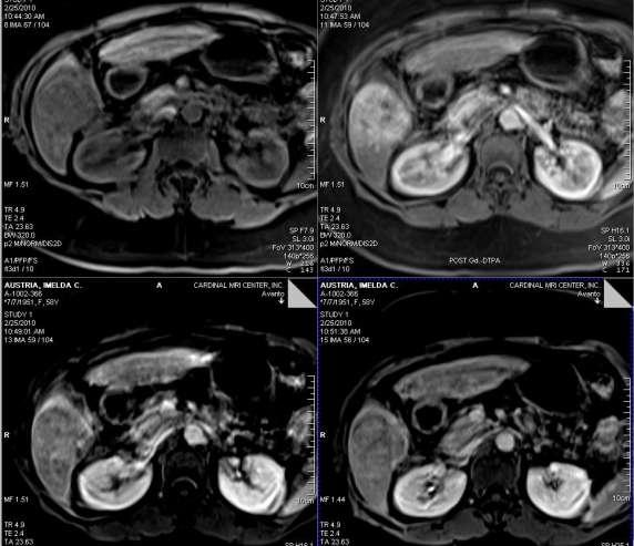 Pre-contrast MRI HCC Arterial Phase Enhancement on arterial
