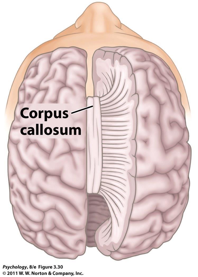 Brain surgery Corpus callosotomy severing corpus callosum