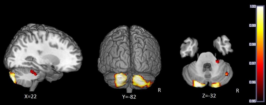 Magnetic Resonance Imaging (MRI) Structural MRI: Looking at the brain s structure Similar methods and identical equipment to fmri Looking at structural effects