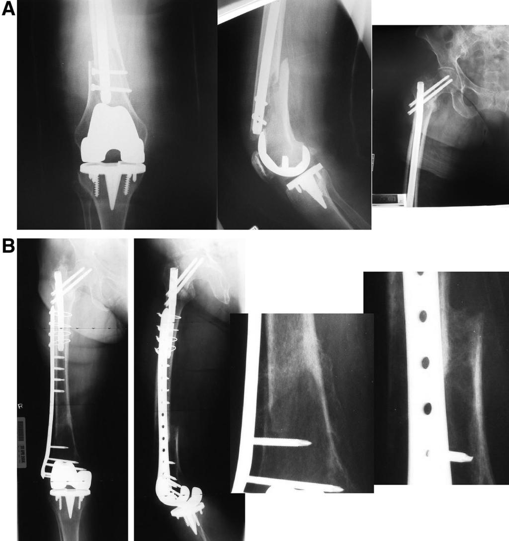 182 K. F. DICKSON AND J. MUNZ FIG. 1. (A) Elderly patient with reported initially nondisplaced periprosthetic fracture who now has an unstable fracture (AP and lateral of knee and AP of hip).