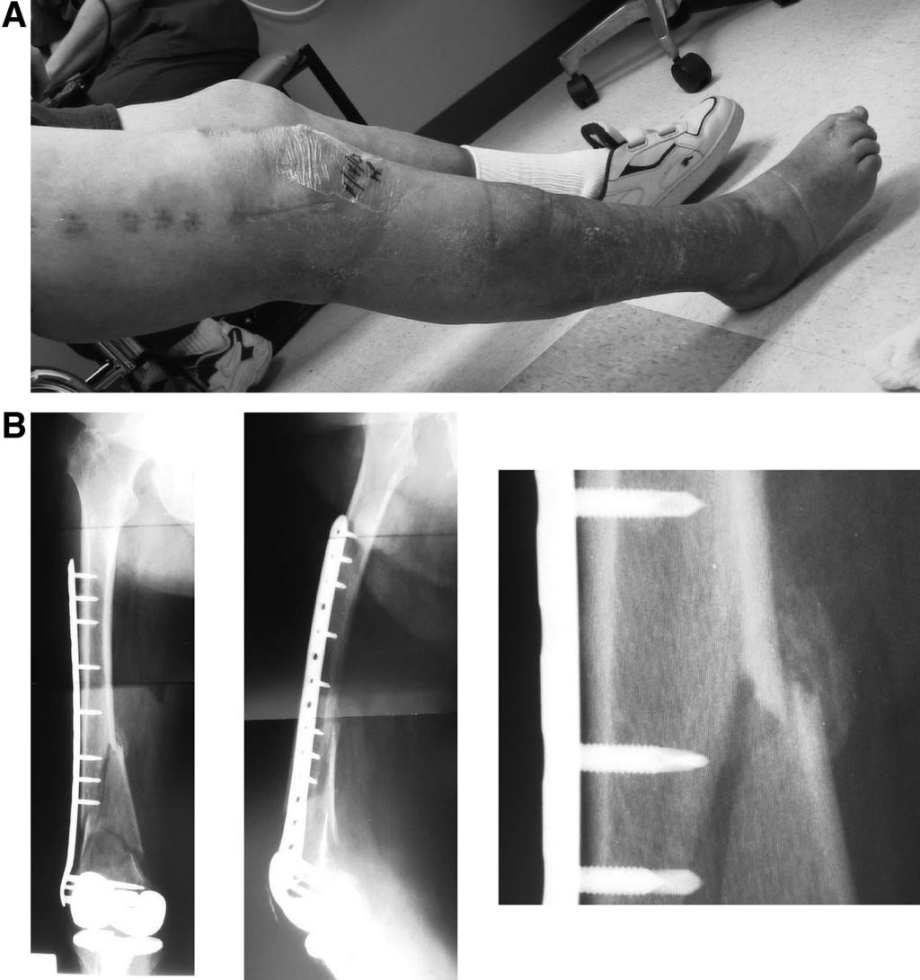 LOCKED PLATING 183 FIG. 2. (A) Elderly patient with a distal femur fracture and significant peripheral vascular disease (clinical photo 4 weeks postoperative).