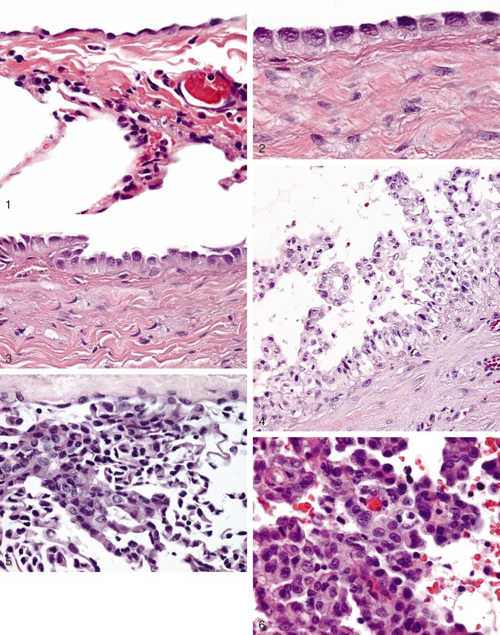 Figure 1. High-power view shows flat, inconspicuous normal mesothelial cells lining the visceral pleural surface (hematoxylin-eosin, original magnification 300). Figure 2.